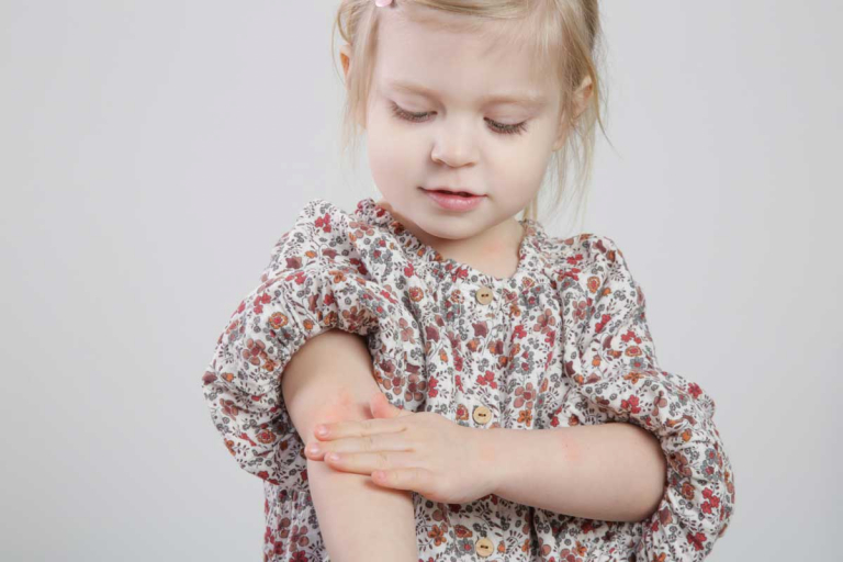 Neurodermitis beim Kind - Maedchen mit empfindlicher Haut