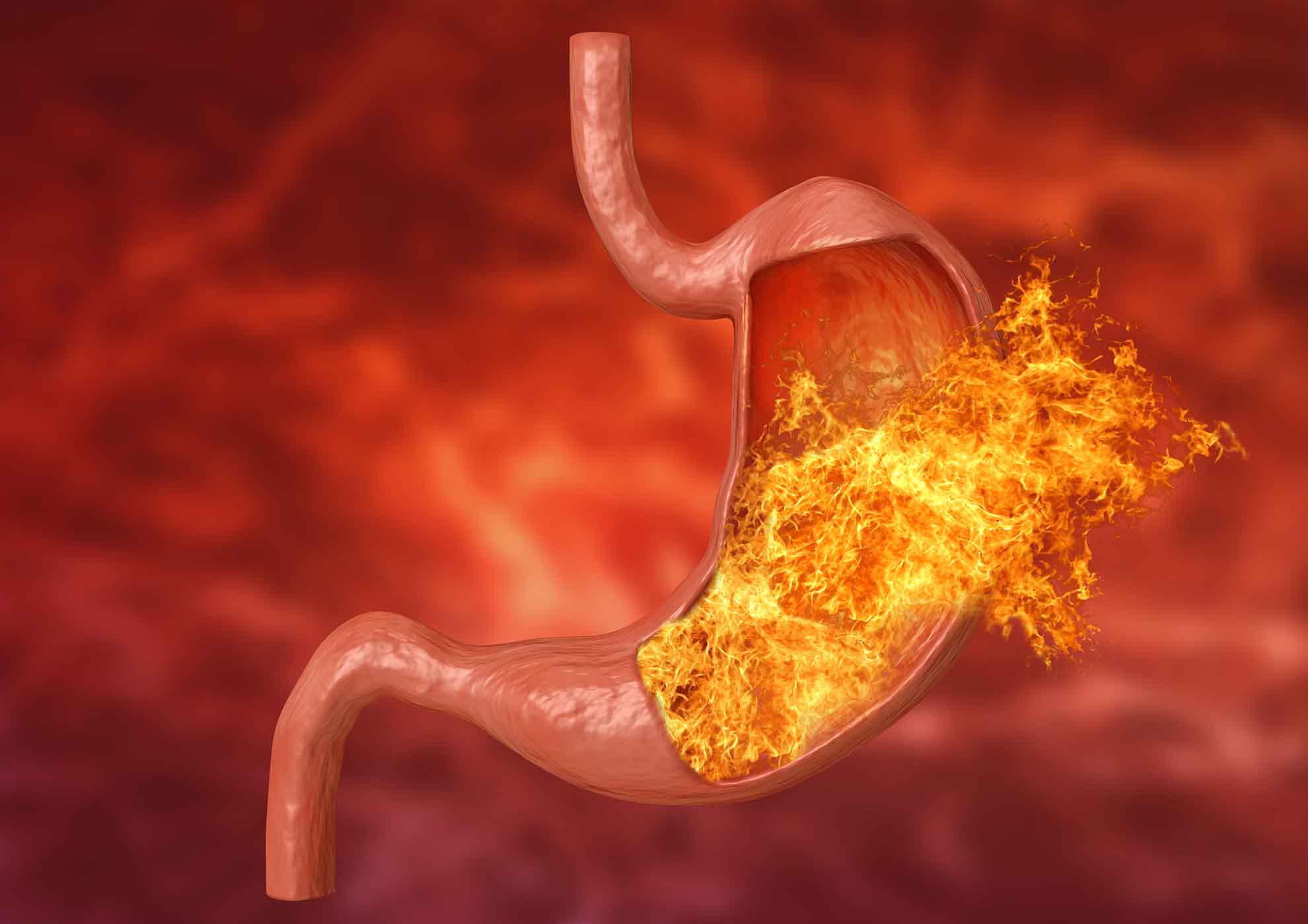 magen brennt Gastritis – eine Entzündung der Magenschleimhaut, die entweder plötzlich auftritt und rasch wieder verheilt oder schleichend auftritt und dauerhaft Beschwerden bereitet.