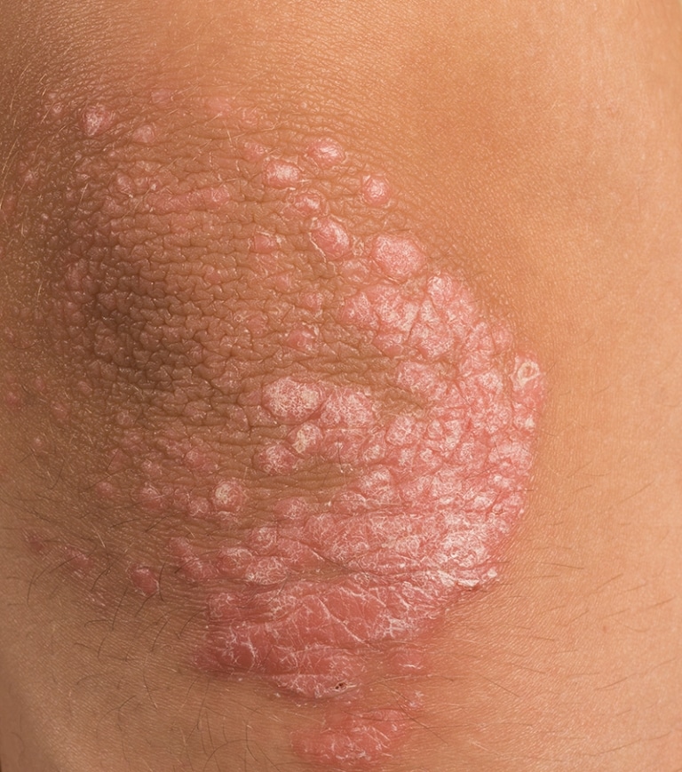 Definition der Psoriasis im „Pschyrembel“, dem klinischen Wörterbuch: "Offensichtlich epidermale Stoffwechselstörung mit überstürzter Epidermisbildung. Die Bereitschaft, psoriatisch zu reagieren, wird autosomal dominant vererbt".