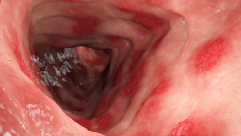 Colitis ulcerosa - Entstehung, Symptome und Verlauf